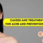 Causes and Treatments for Acne and Prevention Tips