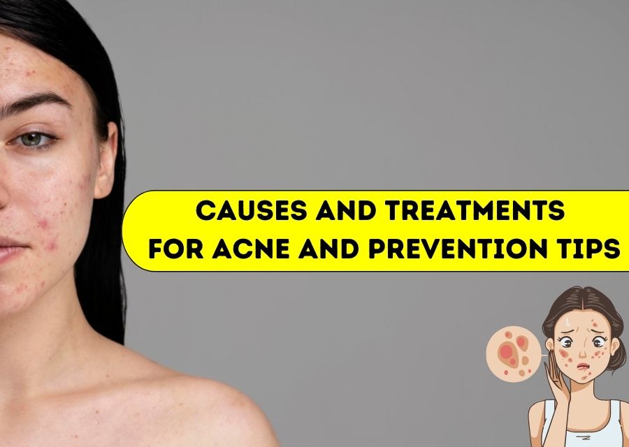 Causes and Treatments for Acne and Prevention Tips