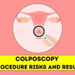 Colposcopy Procedure Risks and Result