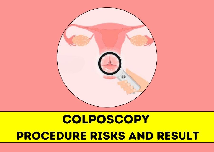 Colposcopy Procedure Risks and Result